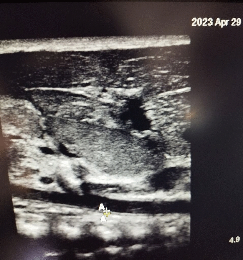 Assessment of Vascular Indices by Abdominal Aortic Ultrasonography in Preterm Neonates with Bronchopulmonary Dysplasia