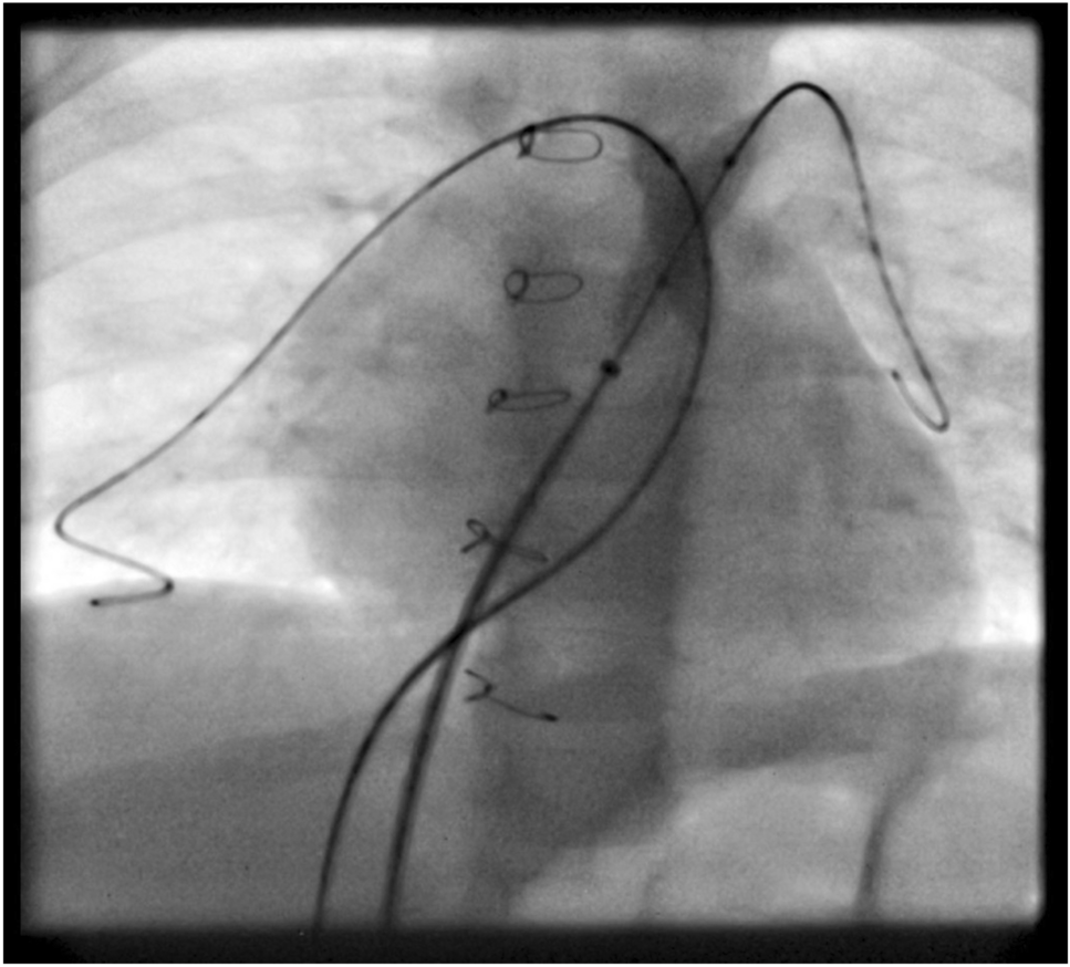 Simultaneous Double Balloon Dilatation for Supravalvar Pulmonary Obstruction After Arterial Switch Operation