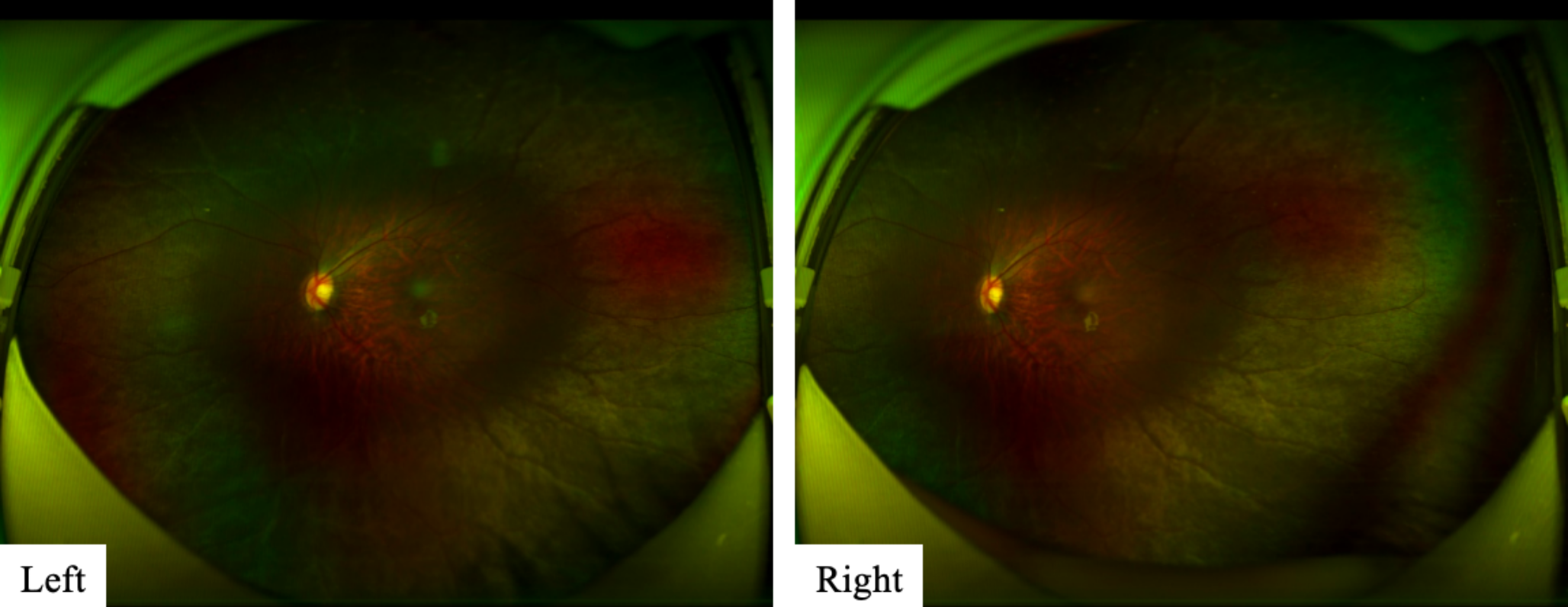 Clinical report and genetic analysis of a Chinese family with retinitis pigmentosa 79 caused by a novel loss-of-function HK1 variant