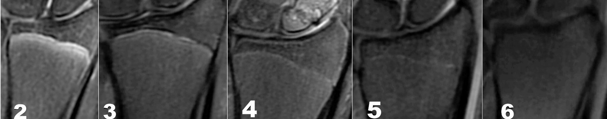 Application of Vieth staging in forensic age estimation in the living using MRI of the distal radial epiphysis