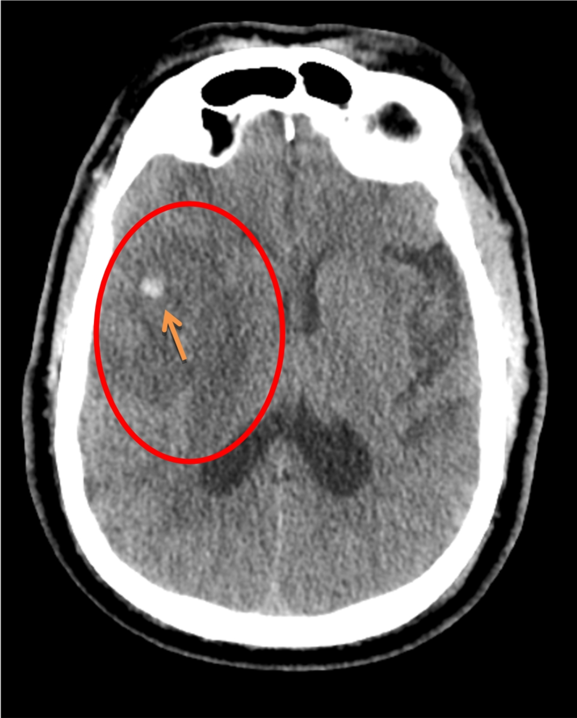 Large right middle cerebral artery stroke with hemorrhagic transformation