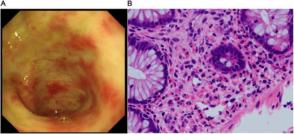 Effect of teduglutide, a glucagon-like peptide-2 analog, in eosinophilic enterocolitis: a case report