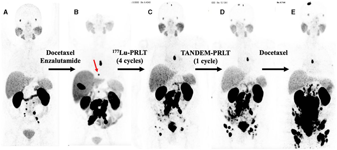 Extraordinary therapeutic effect of PSMA radioligand therapy in treatment-refractory progressive metastatic prostate cancer with the transketolase inhibitor benfo-oxythiamine as a radiosensitizer—A case report