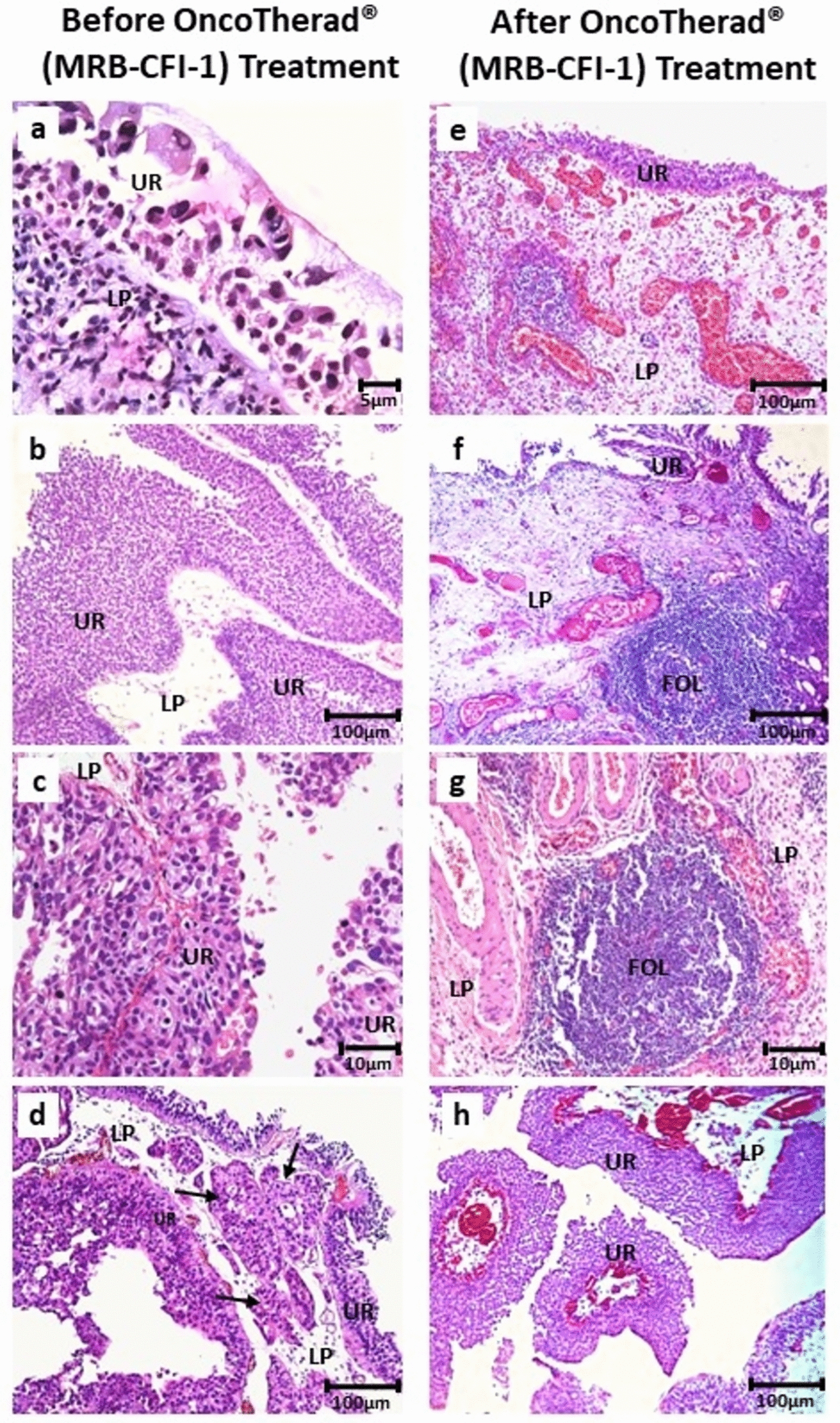 Modulation of the tumor microenvironment in non-muscle-invasive bladder cancer by OncoTherad® (MRB-CFI-1) nanoimmunotherapy: effects on tumor-associated macrophages, tumor-infiltrating lymphocytes, and monoamine oxidases