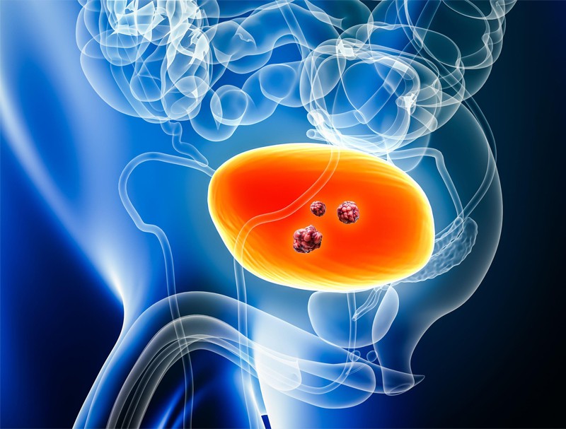 Perioperative immunotherapy for bladder cancer