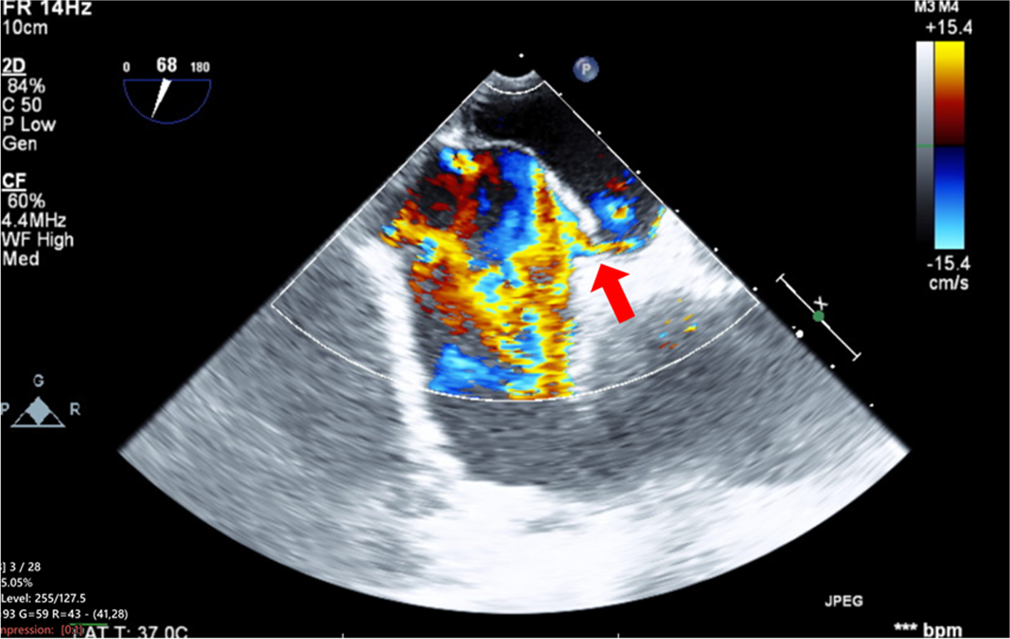 Dynamic shunt flow alterations through patent foramen ovale during off-pump coronary artery bypass grafting induced by airway pressure changes: a case report