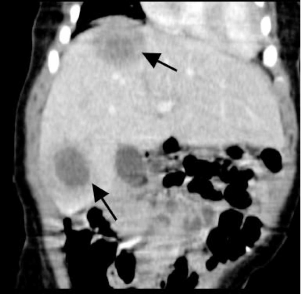 Chromobacterium violaceum infections in children: two case reports and literature review