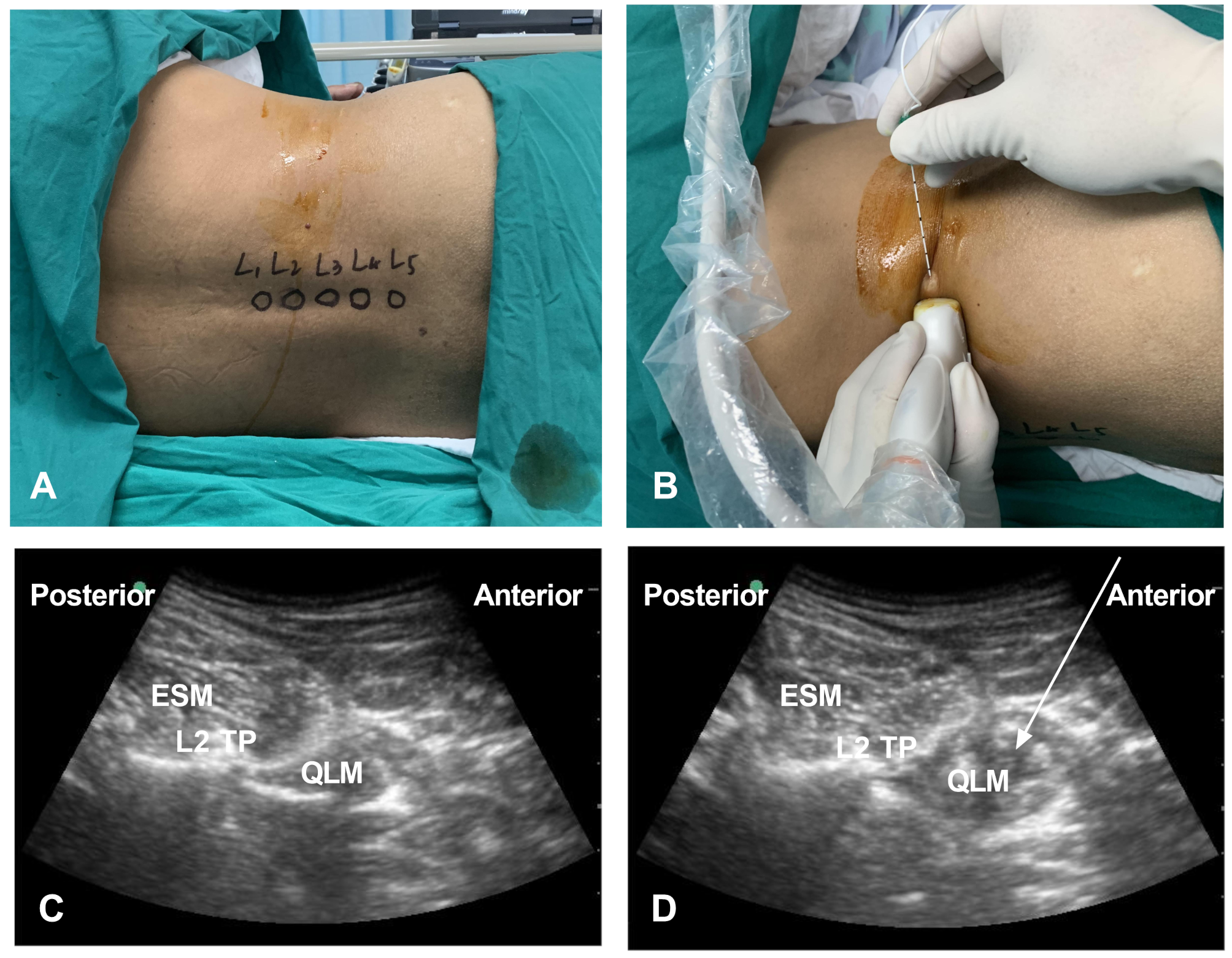 Sensory assessment of intramuscular quadratus lumborum block at the L2 level in open inguinal hernia repair patients