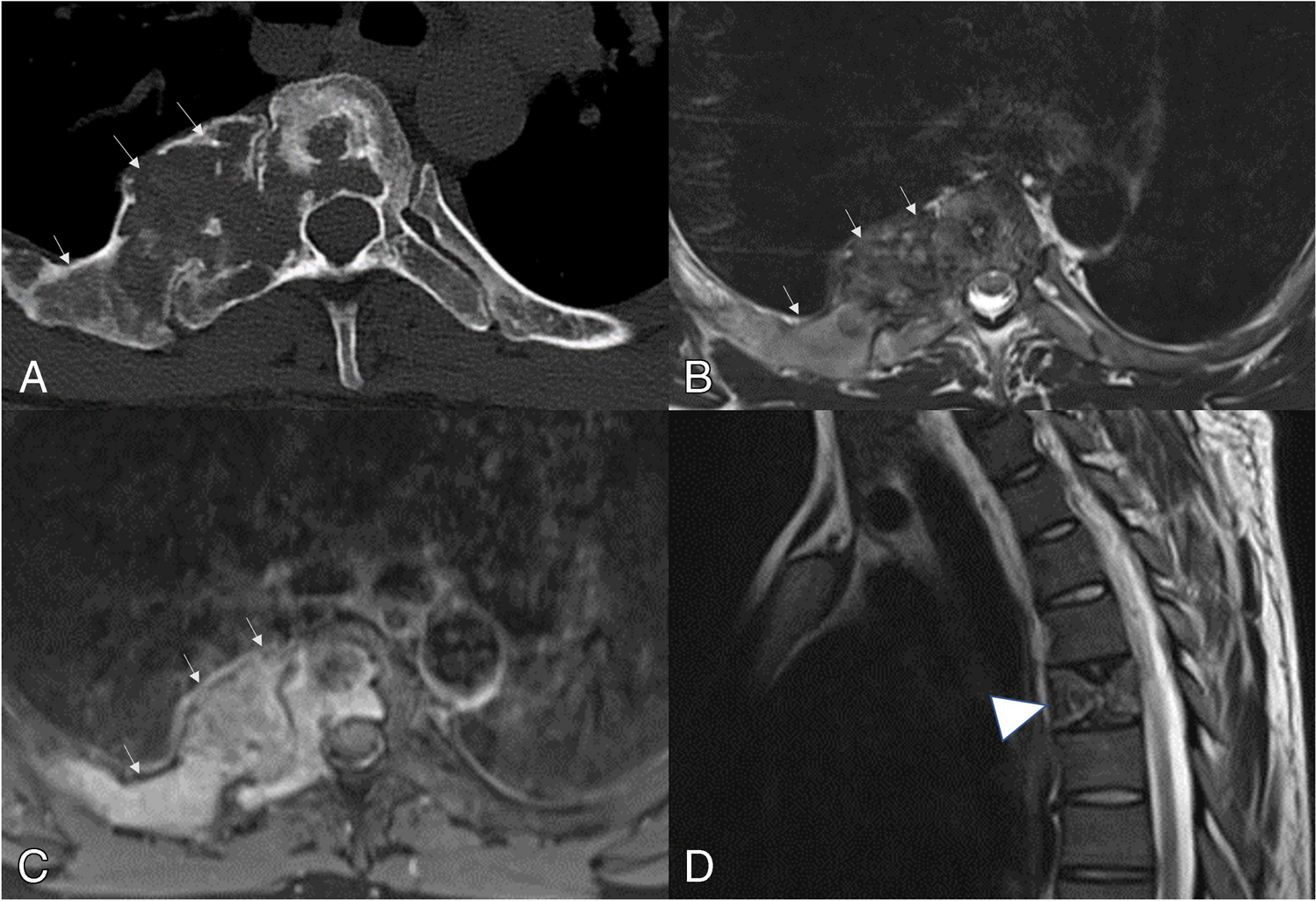 A 32-year-old man with upper back pain following a minor fall