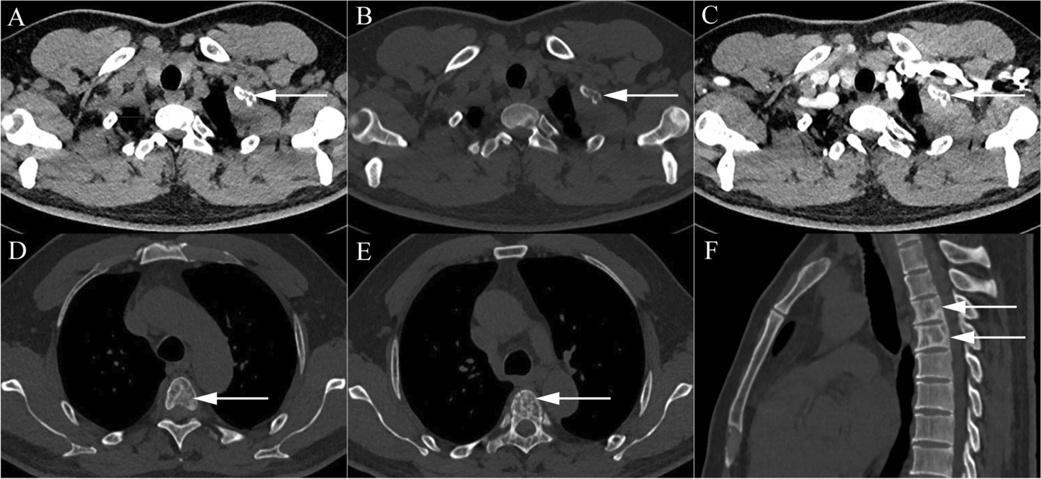 Desmoplastic small round cell tumor of bone revealed by 18F-FDG PET/CT: a case report with literature review