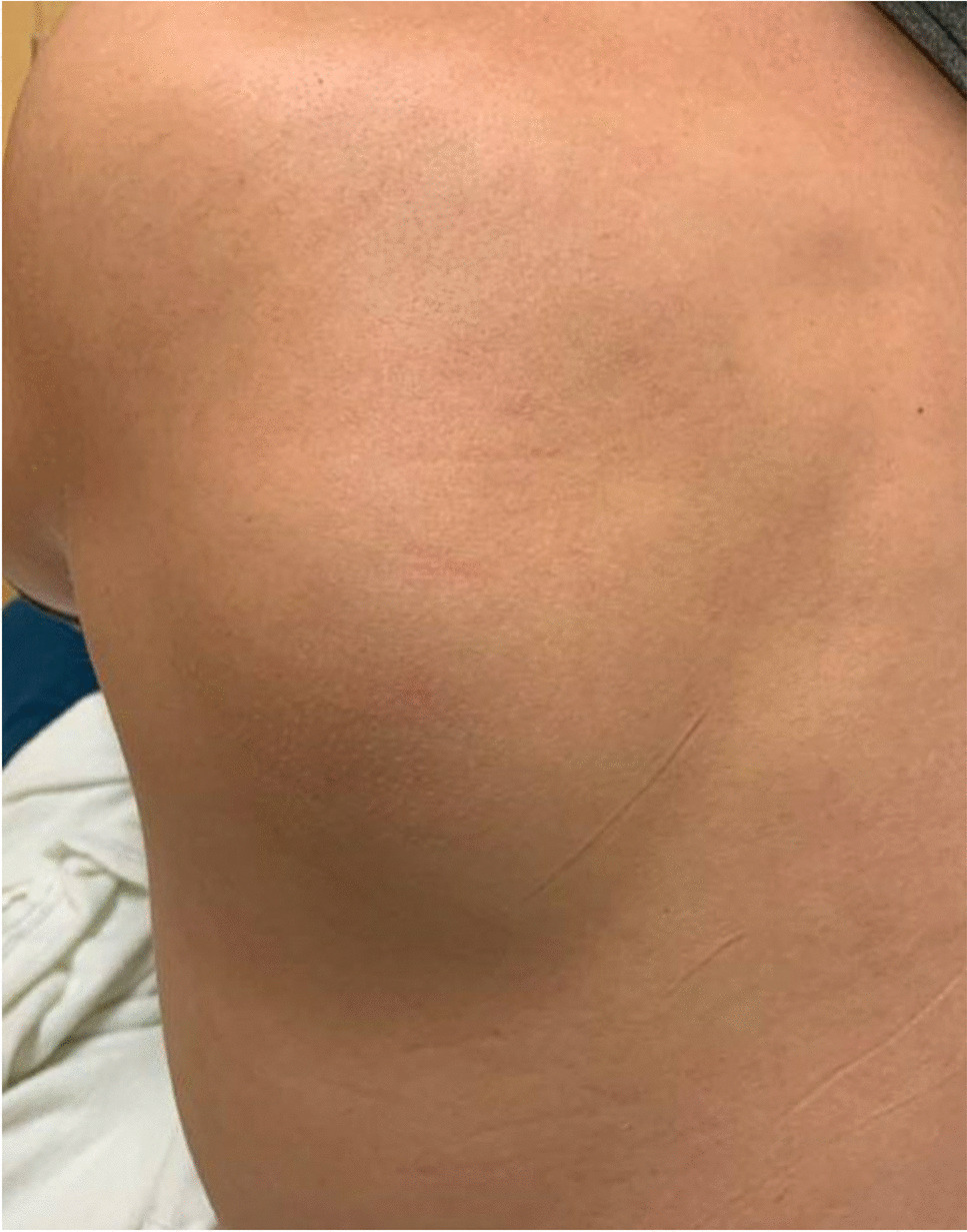 A 22-year-old man with a posterior left shoulder mass