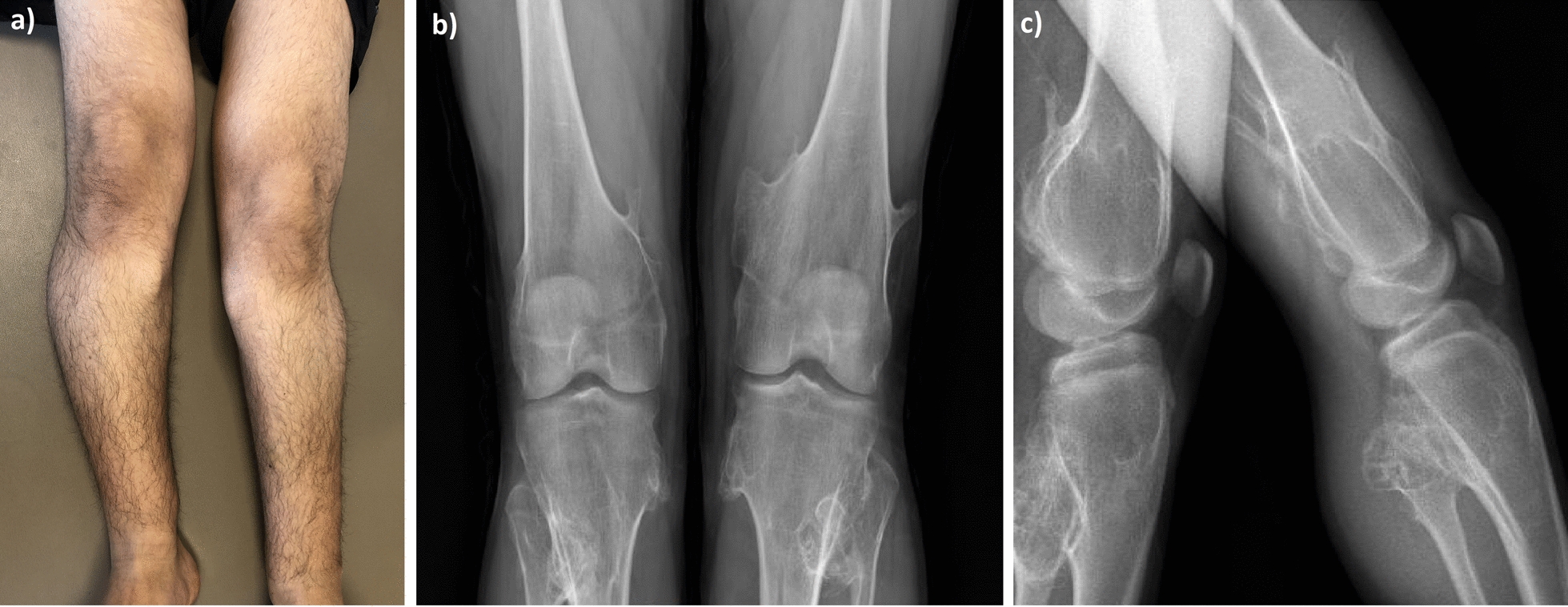 Novel EXT1 variants cause divergent symptom severity in multiple cartilaginous exostoses: a family report