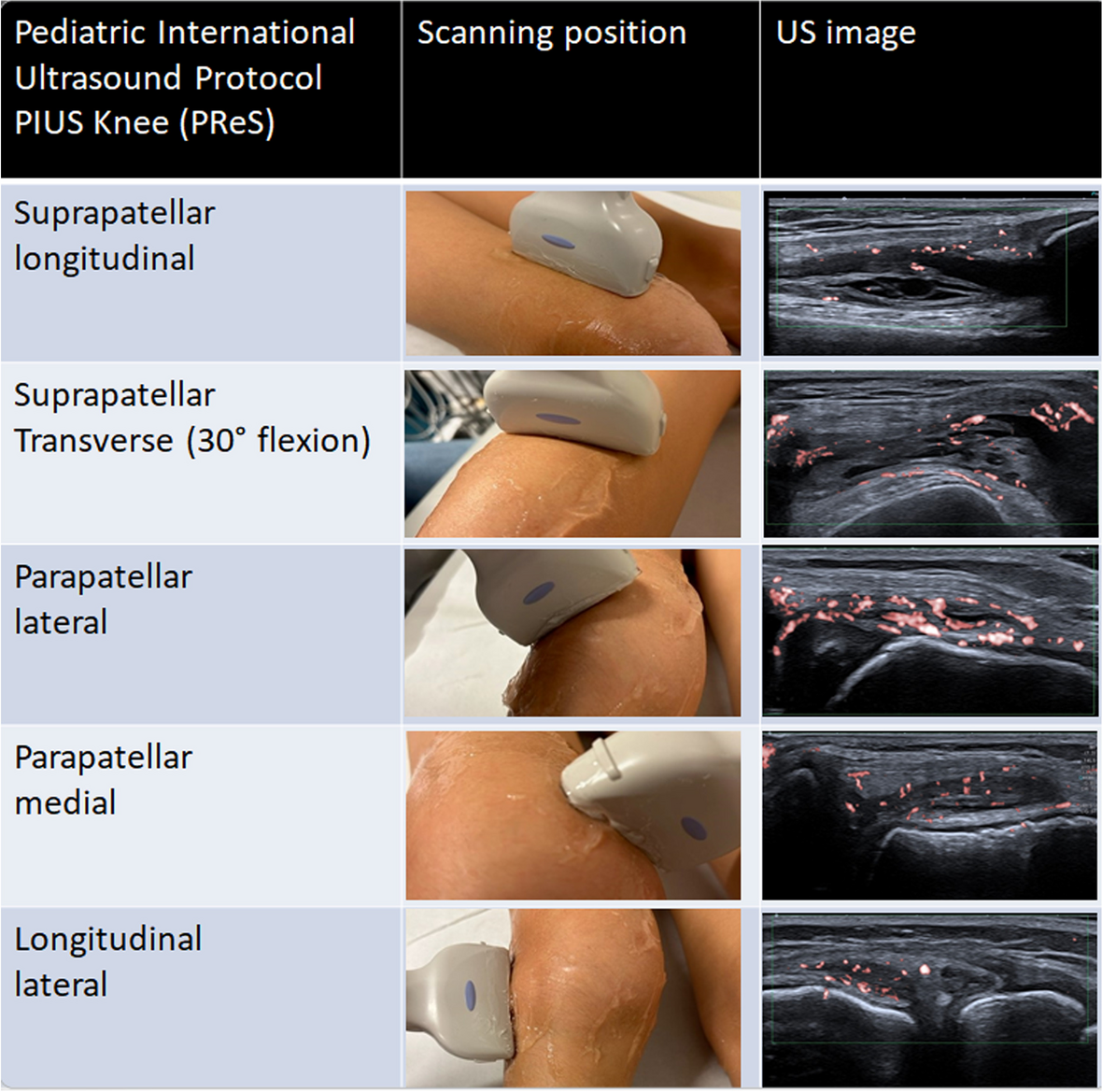 Development and validation of a pediatric internationally agreed ultrasound knee synovitis protocol (PIUS-knee) by the PReS imaging working party