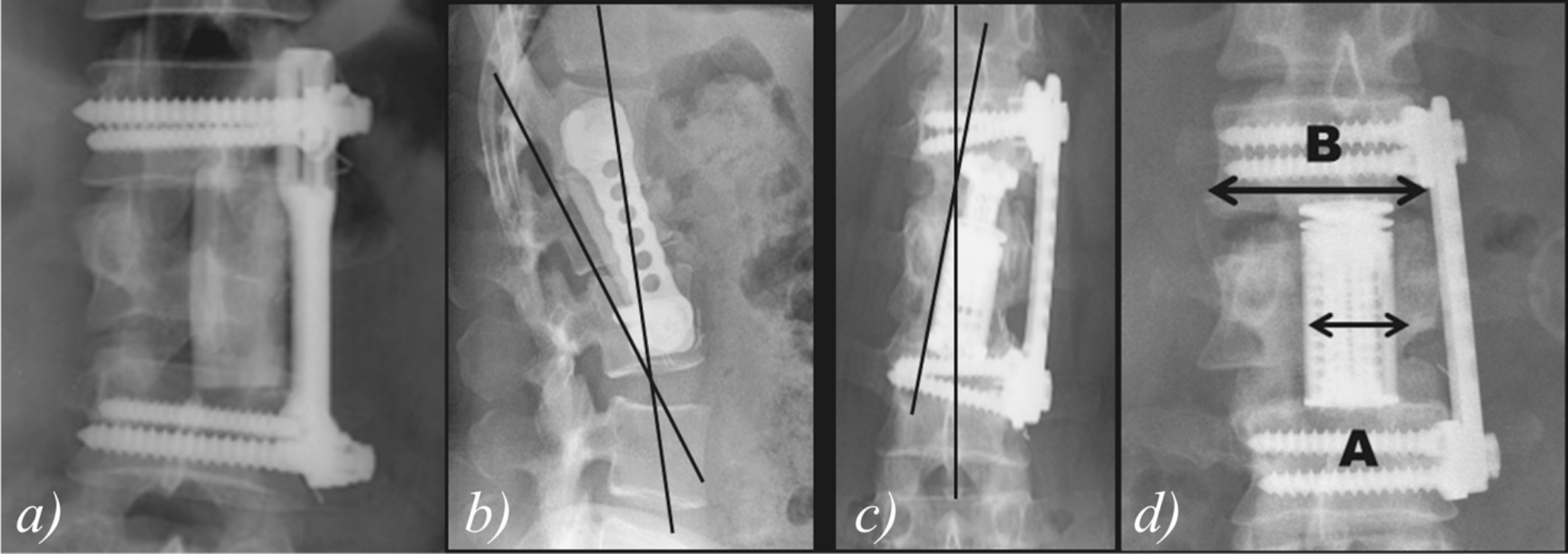 Outcomes for standalone anterolateral corpectomy for thoracolumbar burst fractures