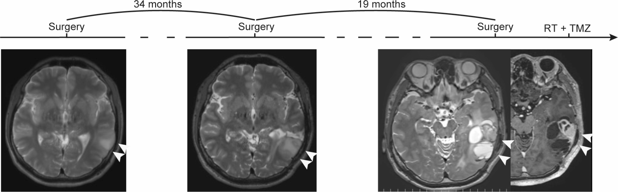 Dual phenotypes in recurrent astrocytoma, IDH-mutant; coexistence of IDH-mutant and IDH-wildtype components: a case report with genetic and epigenetic analysis