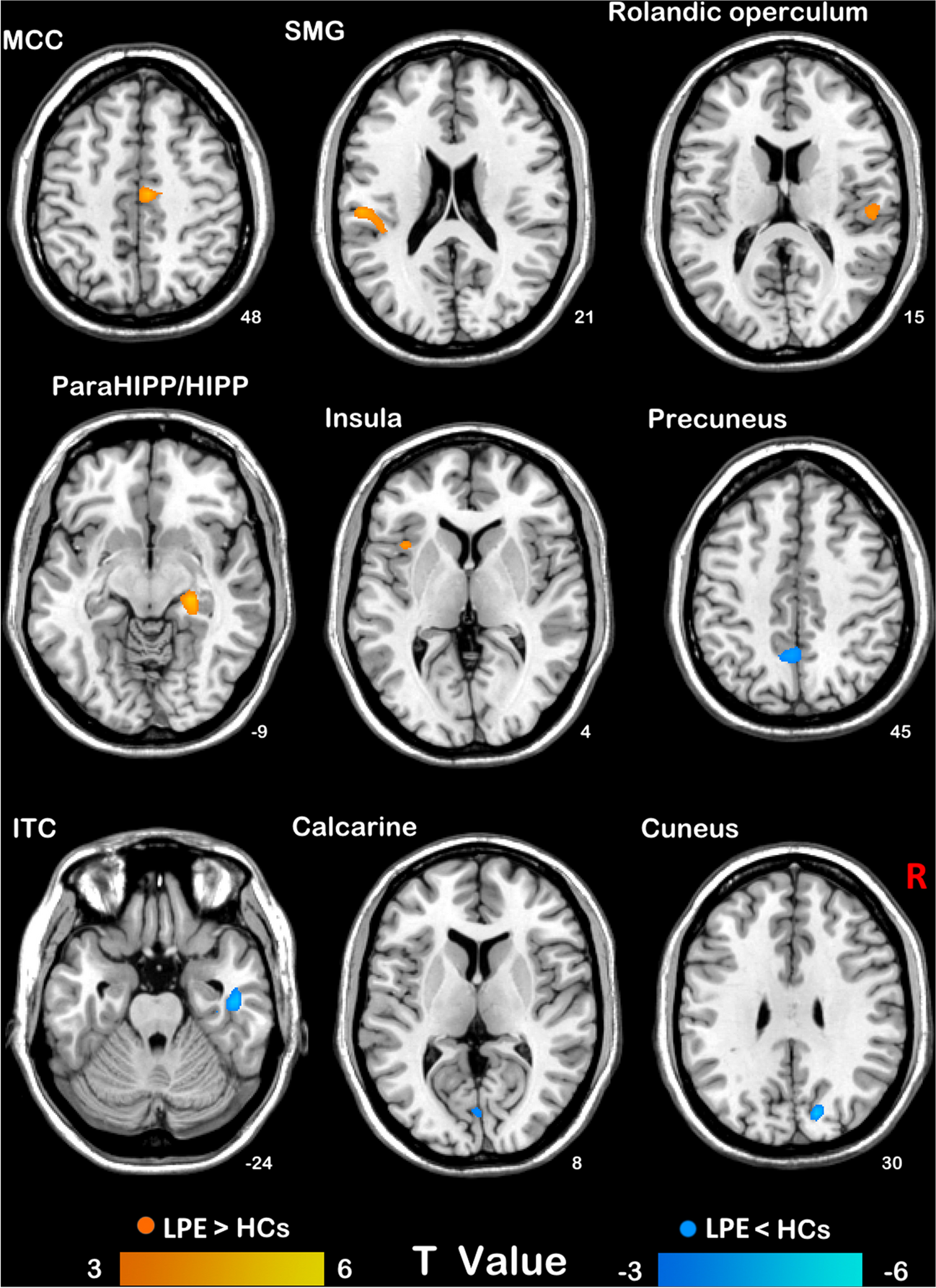 Abnormal percent amplitude of fluctuation in patients with lifelong premature ejaculation is associated with neurotransmitter profiles