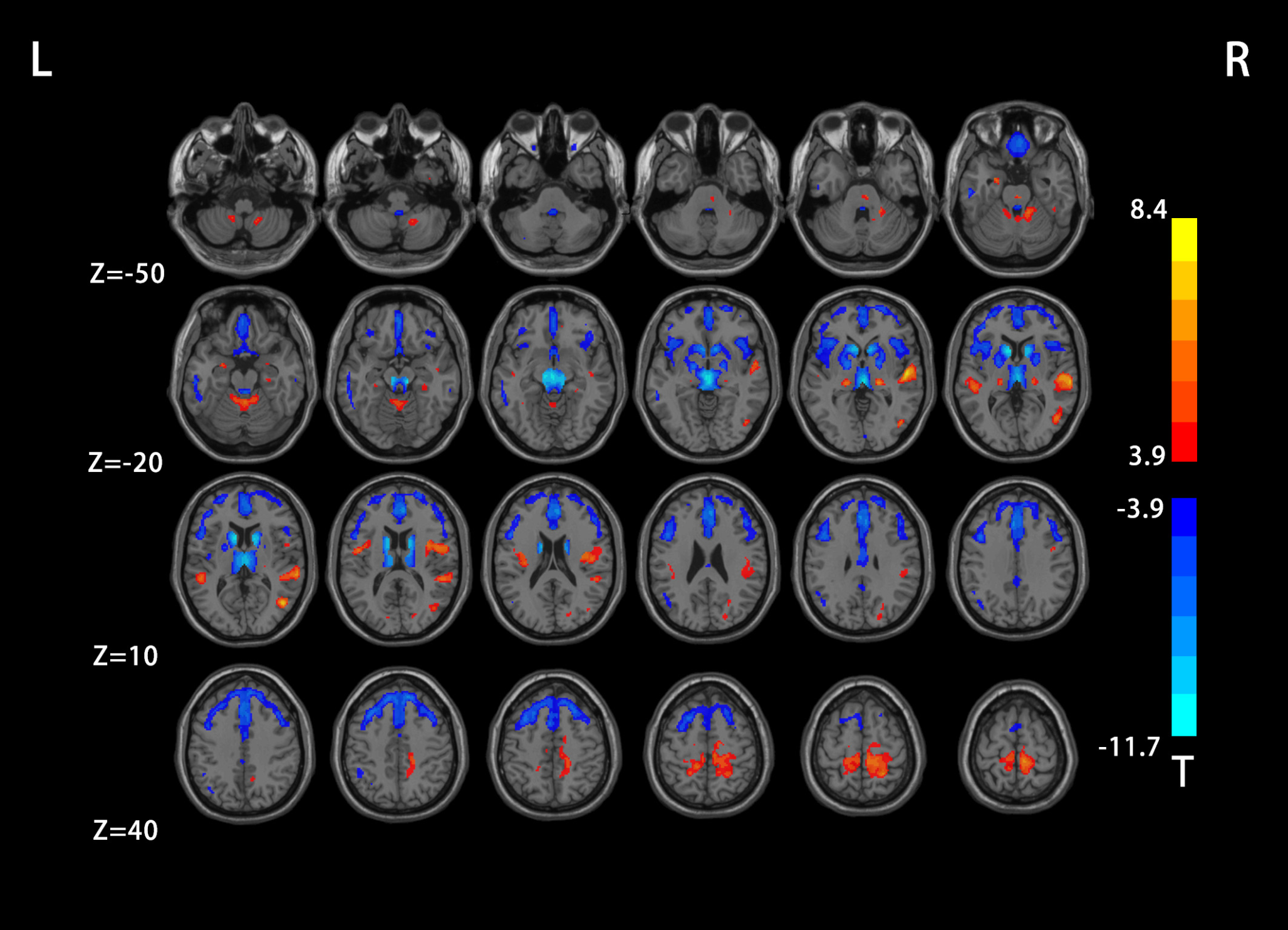 Identification of metabolic progression and subtypes in progressive supranuclear palsy by PET molecular imaging