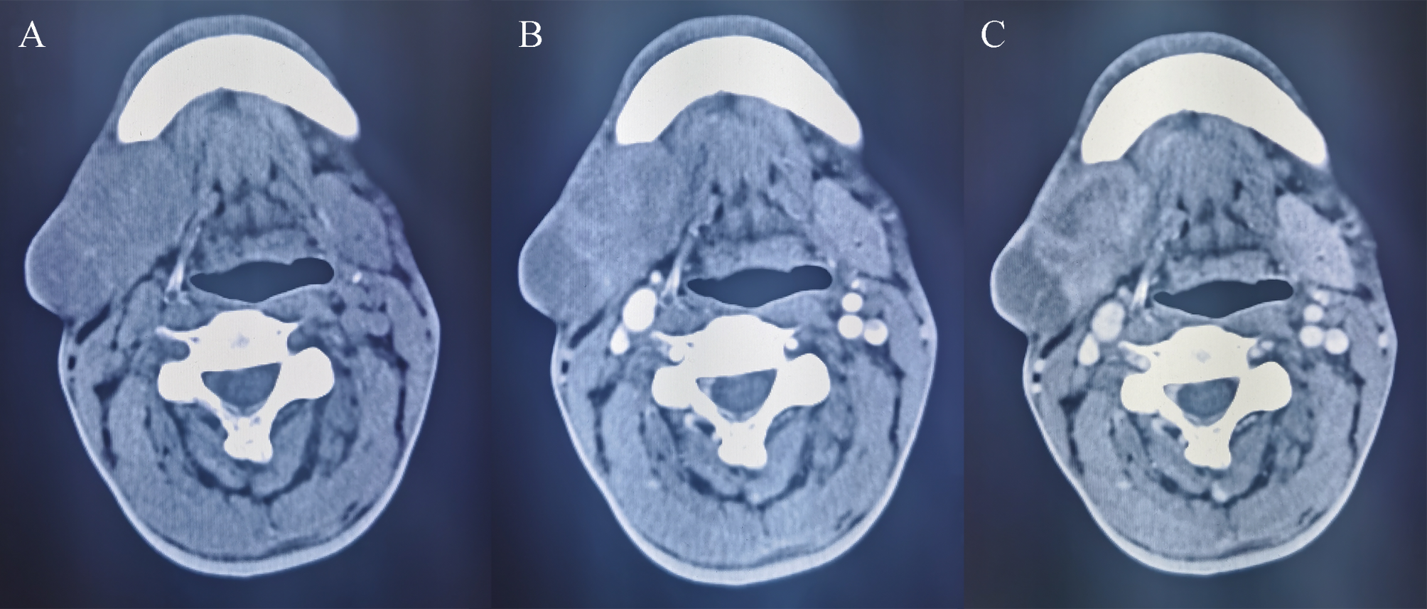 Clinicopathologic characterization of secretory carcinoma of salivary gland