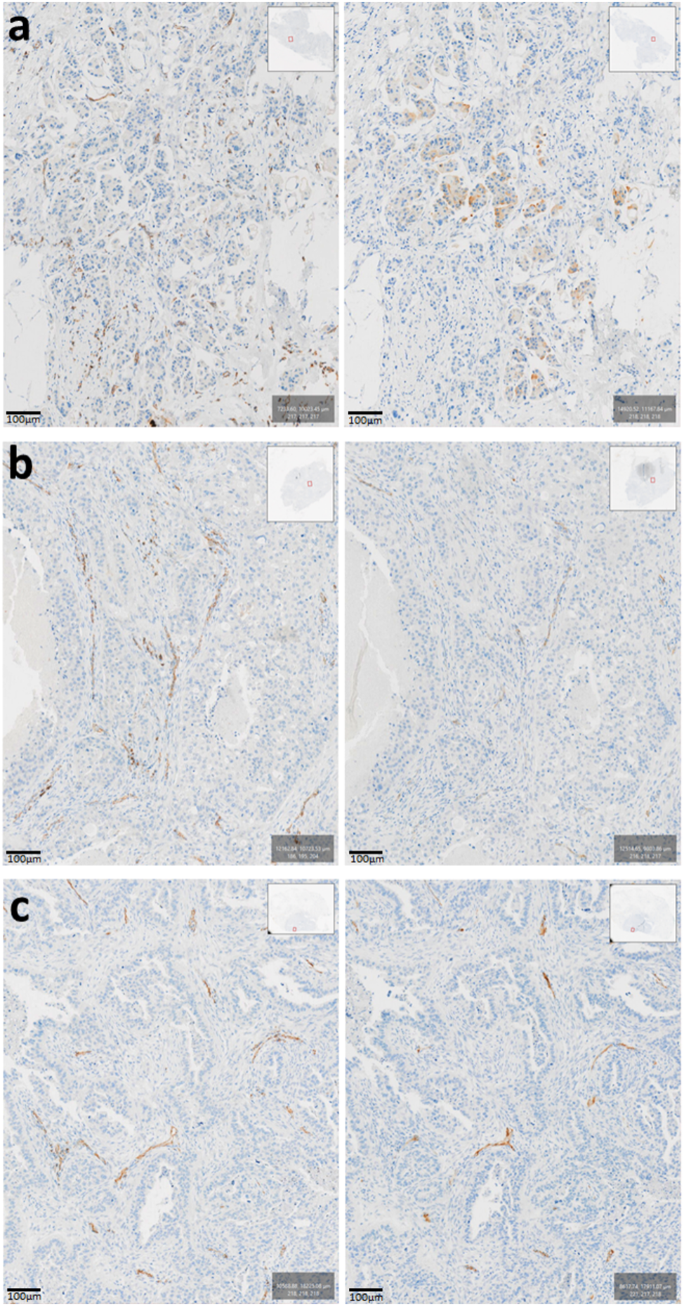 Potential of PSMA for breast cancer in nuclear medicine: digital quantitative immunohistochemical analysis and implications for a theranostic approach