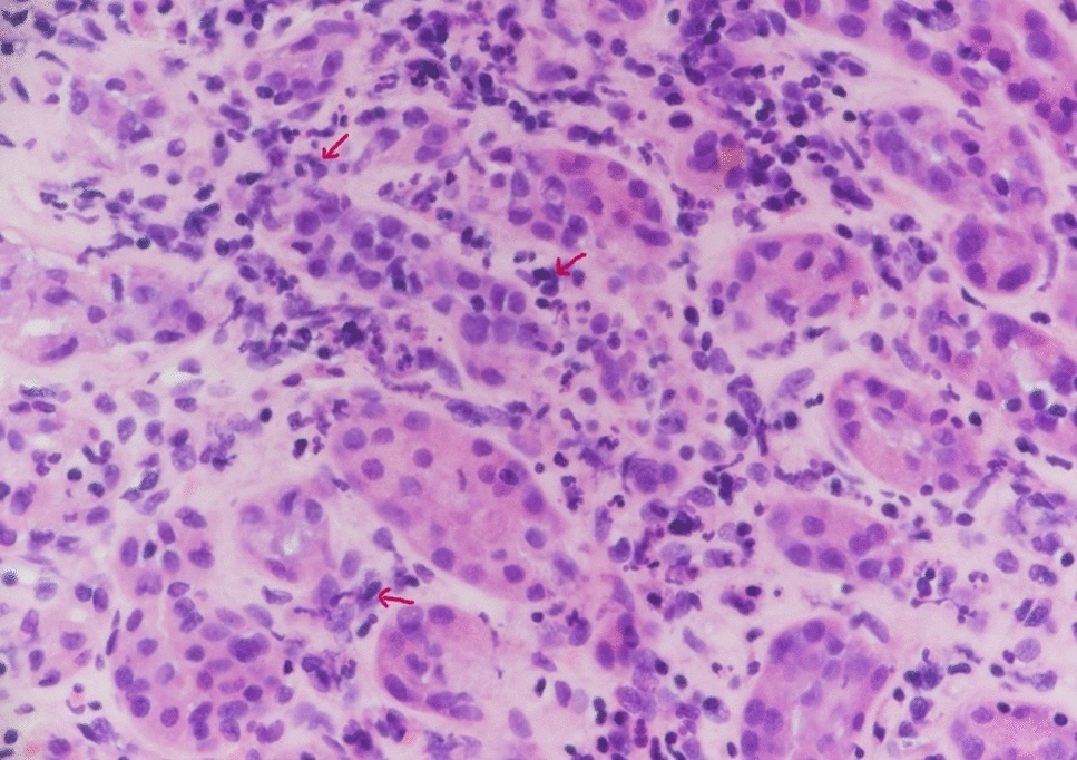 Acute tubulointerstitial nephritis associated with infliximab therapy in a patient with Crohn’s disease: a case report