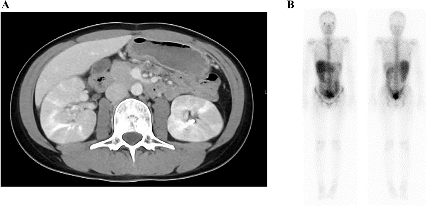 Acute tubulointerstitial nephritis following coronavirus disease 2019 mRNA vaccination: a pediatric case report