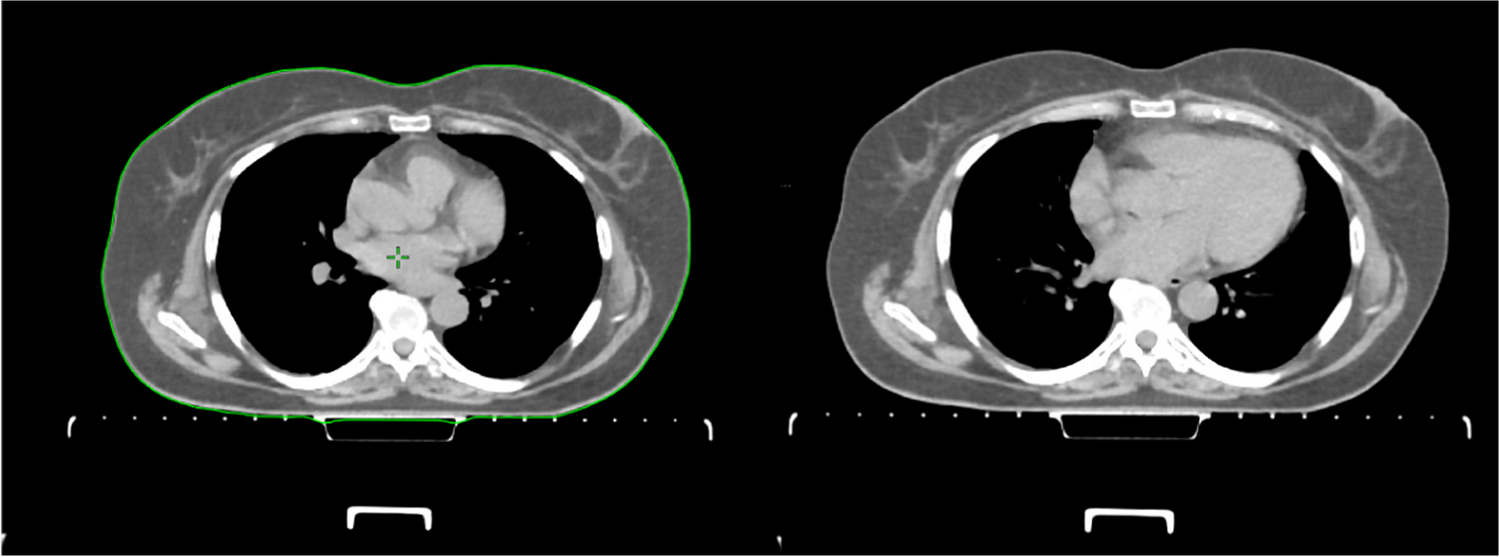 Heart is a heavy burden: cardiac toxicity in radiation oncology