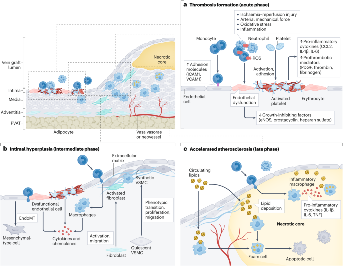 Nanomedicine-based strategies for the treatment of vein graft disease