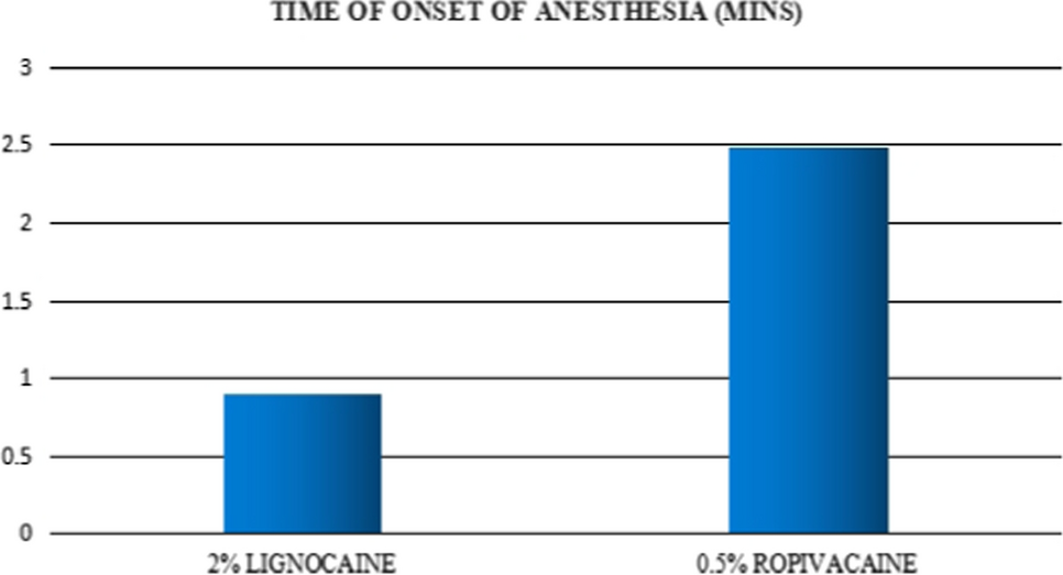 Comparison of Efficacy of 0.5% Ropivacaine Versus 2% Lignocaine Hydrochloride with Adrenaline (1:80,000) in Surgical Removal of Impacted Mandibular Third Molars with Emphasis on Depth of Anesthesia- Prospective, Randomized, Split Mouth Study