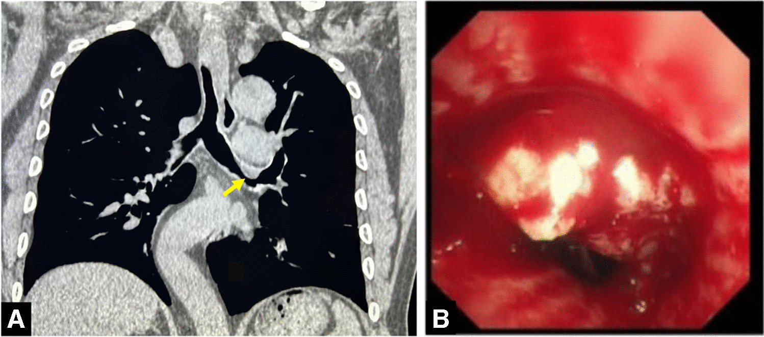 Bronchial salivary gland-type mucinous adenocarcinoma harboring a GNAS mutation: a novel lung cancer entity? A case report