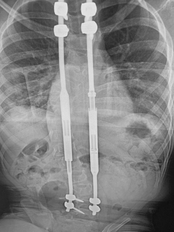 Is MAGEC X better than earlier designs of magnetically controlled growing rod: an explant study