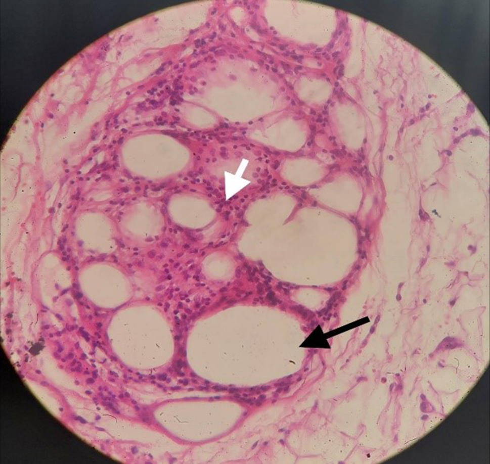 Orbital and peri-ocular parffinoma: case series and literature review