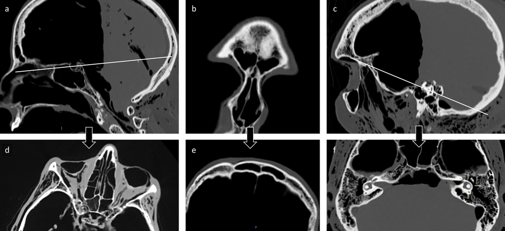 Identification score for robust and secure identification using ante- and post-mortem skull CT scans