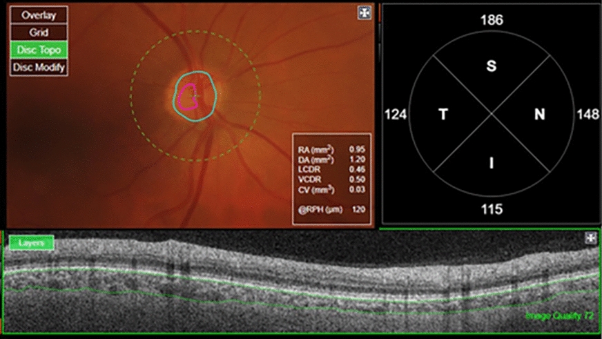 A small disc size, a big challenge: effect of optic disc size on the correlation between peripapillary choroidal thickness, peripapillary retinal nerve fiber layer, and ganglion cell layer