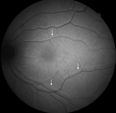 Unveiling macular displacement: endotamponade variations in retinal detachment repair outcomes