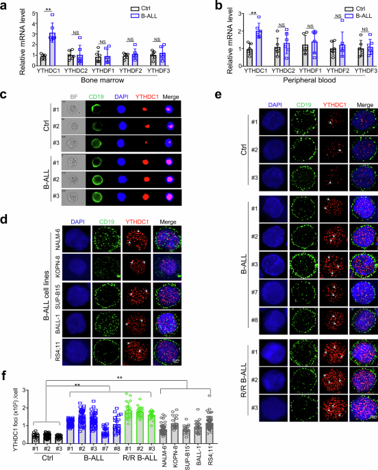 YTHDC1 is a therapeutic target for B-cell acute lymphoblastic leukemia by attenuating DNA damage response through the KMT2C-H3K4me1/me3 epigenetic axis