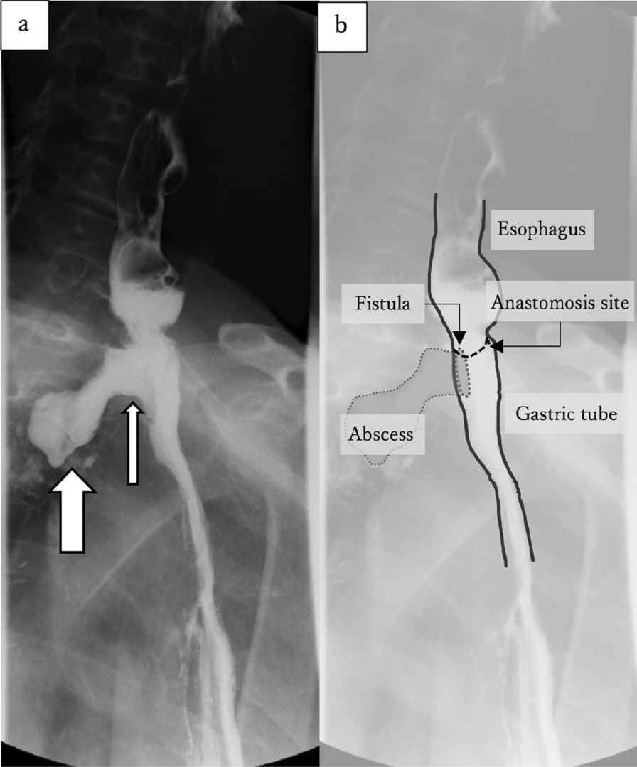 Gastro-tracheal fistula following esophageal cancer surgery through the retrosternal route: a case report