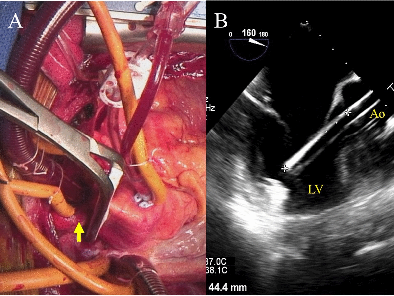 Left ventricular perforation by Impella 5.5 during surgery for postinfarction ventricular septal rupture