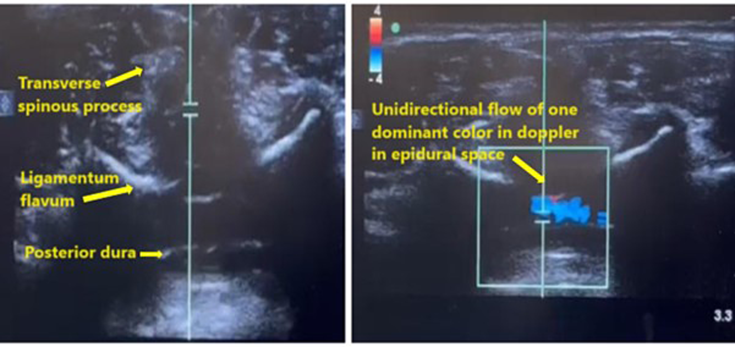 Ultrasound guided pediatric caudal dose: a two-center randomized controlled trial