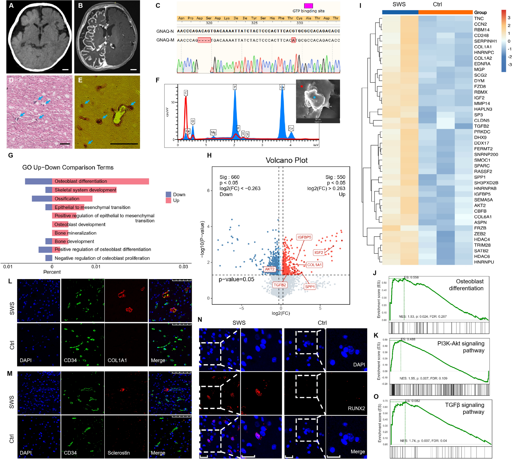 Vascular Ossification in the Developing Brain: A Case Study of Pediatric Sturge Weber Syndrome