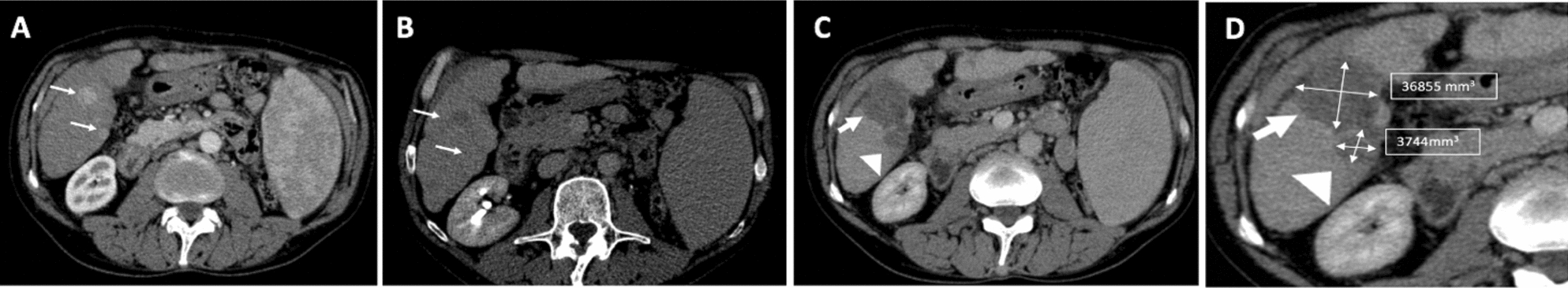 Percutaneous microwave ablation of HCC: comparison between 100 and 150 W technology systems