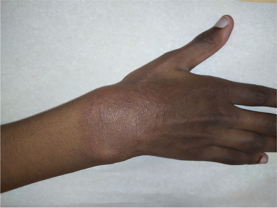 Pediatric case of immune-mediated necrotizing myopathy with anti-HMGCR antibodies and dermatomyositis skin rash