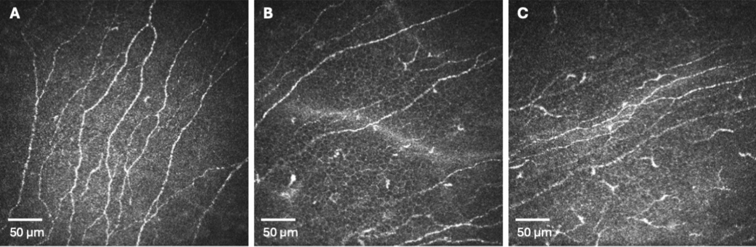 Subclinical corneal inflammation and subbasal nerve alterations in keratoconus detected by in vivo confocal microscopy: a cross-sectional study