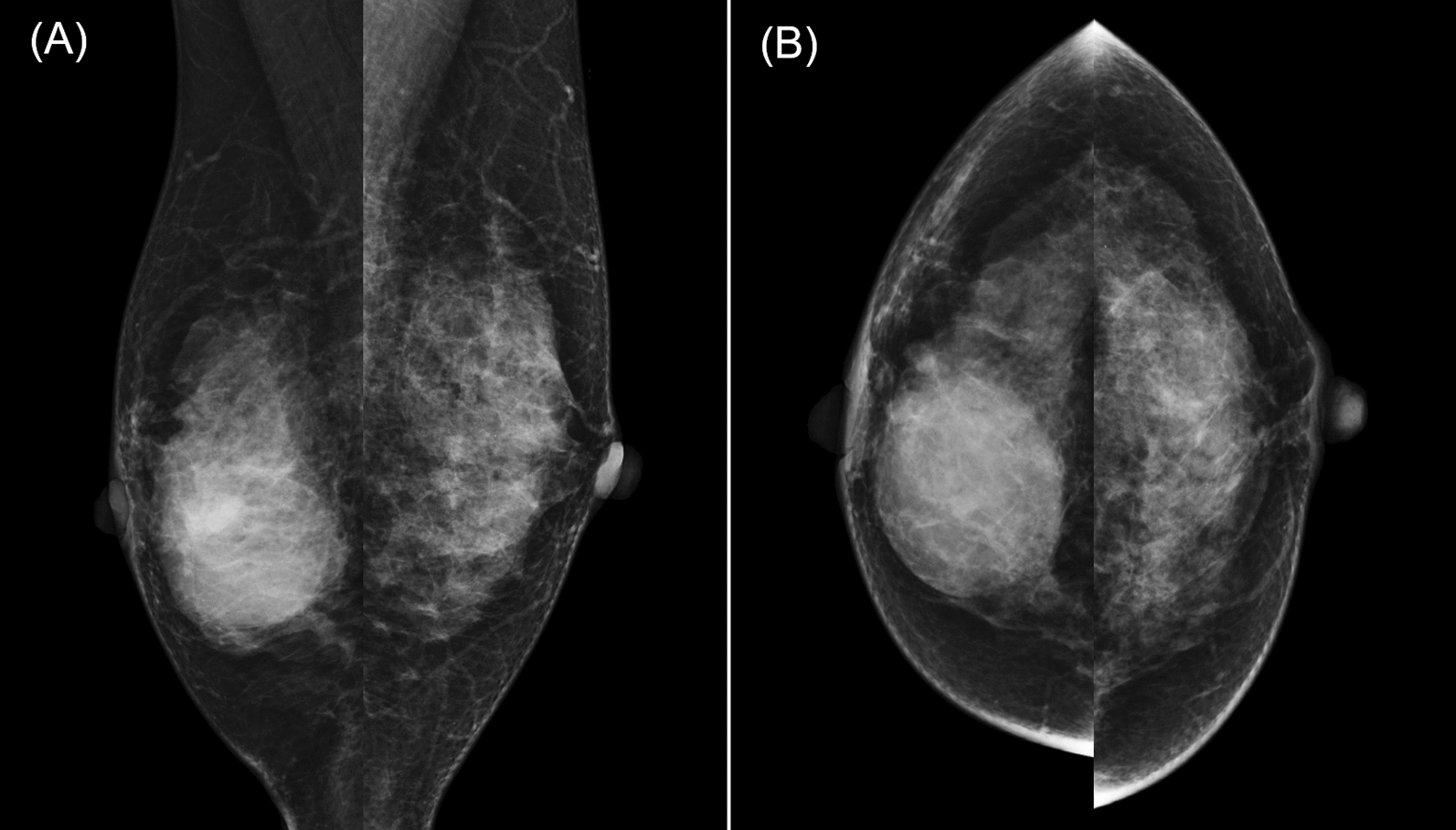 Granulomatous mastitis forming a well-defined large mass diagnosed by surgical excision: a case report