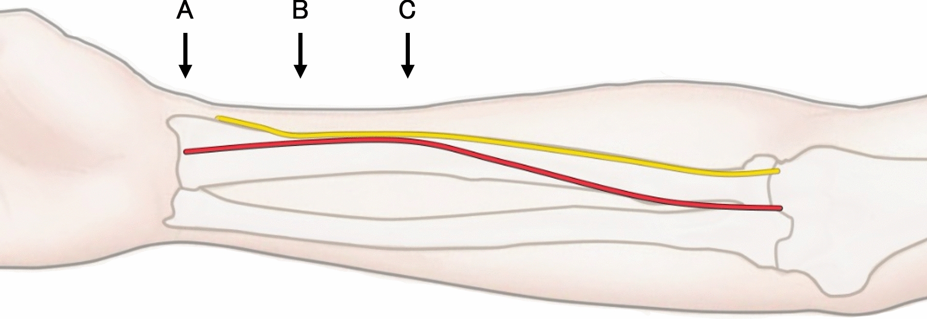 Margin of safety for needle puncture of a radial artery in children: Recommendation for ultrasound-guided cannulation