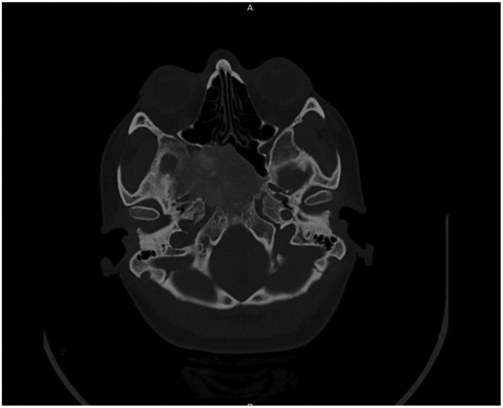 Fibrous Dysplasia of Sphenoid: A Case Report