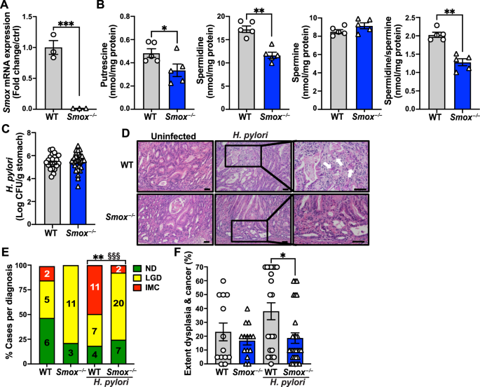 Spermine oxidase promotes Helicobacter pylori-mediated gastric carcinogenesis through acrolein production