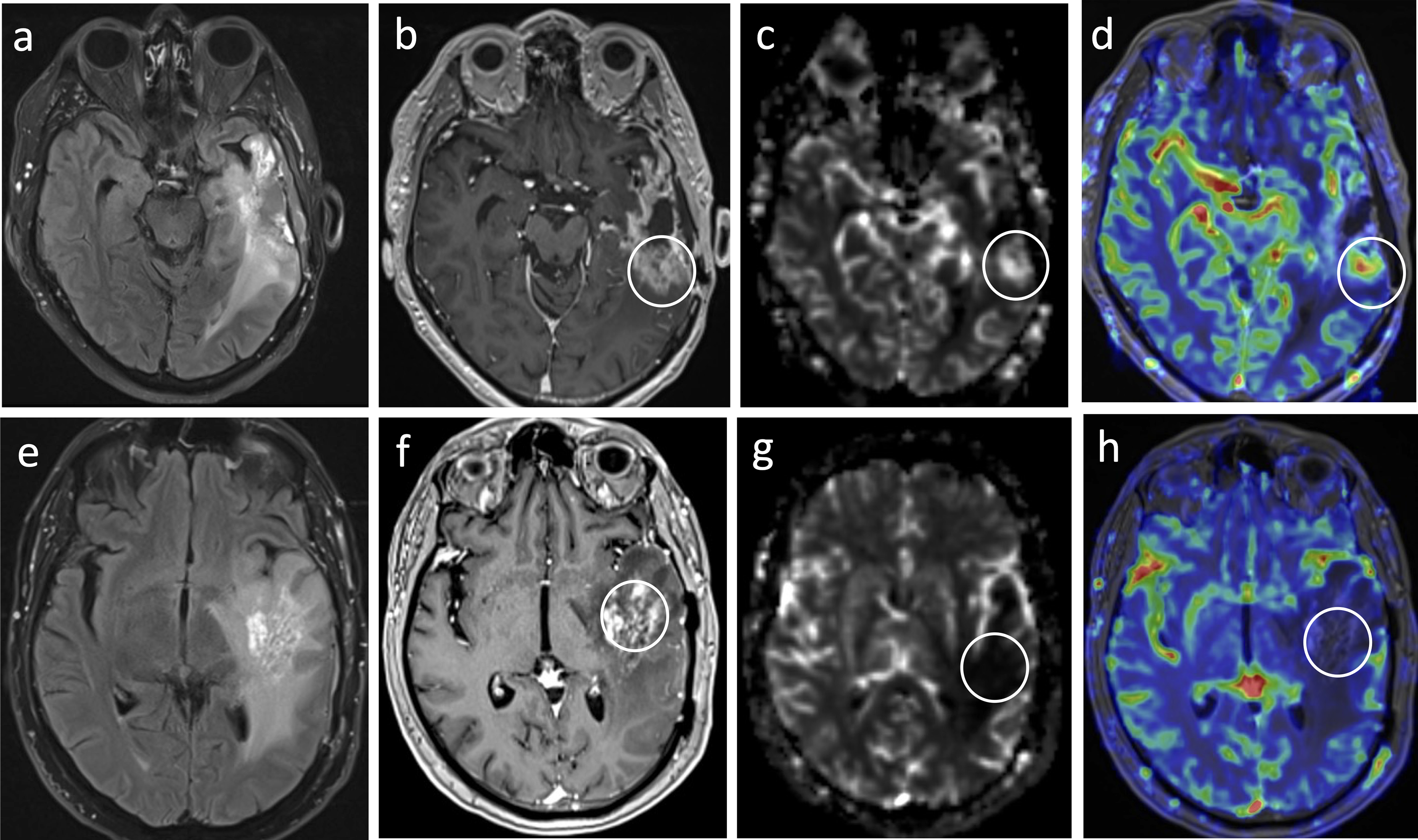 Magnetic resonance imaging techniques for monitoring glioma response to chemoradiotherapy