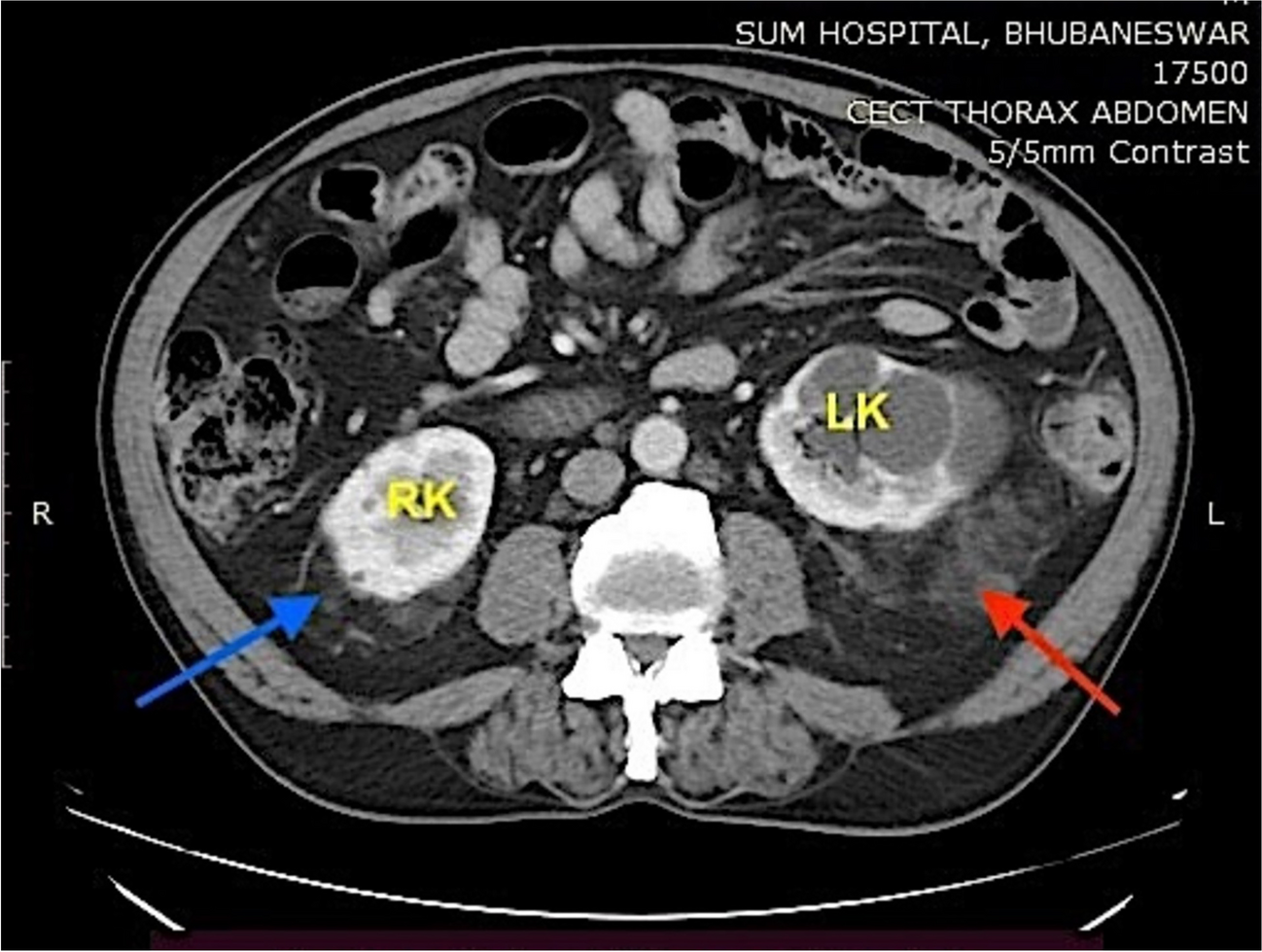 Bilateral Extra-adrenal Myelolipoma: A Rare Case with Literature Review