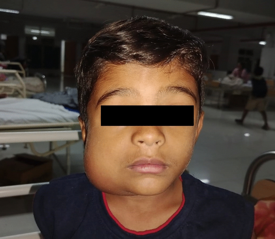 Pediatric Flummox: Deciphering AV Malformation in Submandibular Gland