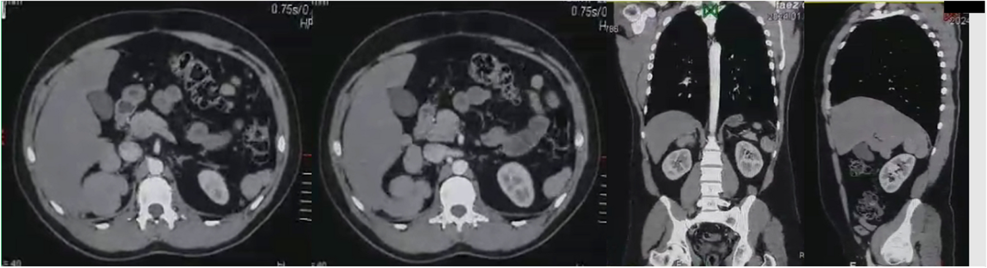 Unveiling three accessory spleens in one patient: a rare case report and literature review